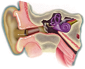 Ear - With Canal Hearing Instrument, in the ear canal.